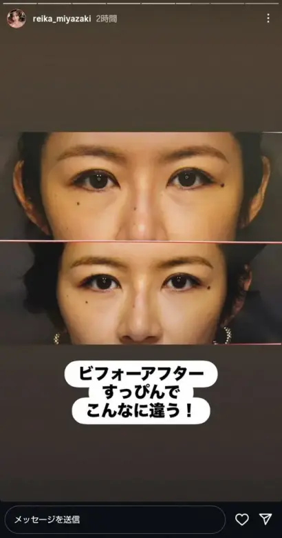 【画像・写真】宮崎麗果「すっぴんでこんなに違う」美容整形のビフォアフ公開「まだまだ3カ月ぐらいかけて完成形に」